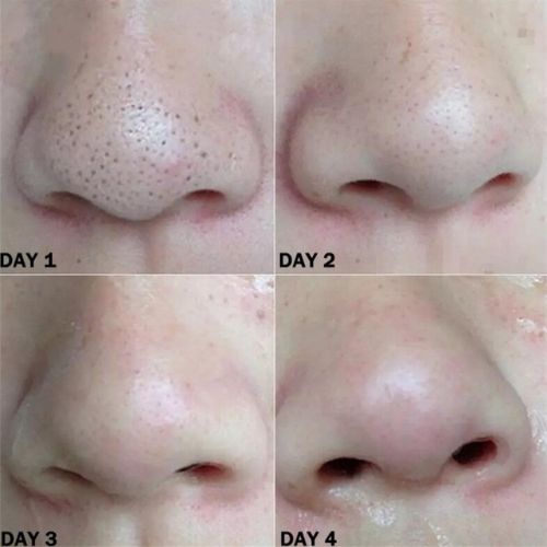 Deep-Clean Pore Strips